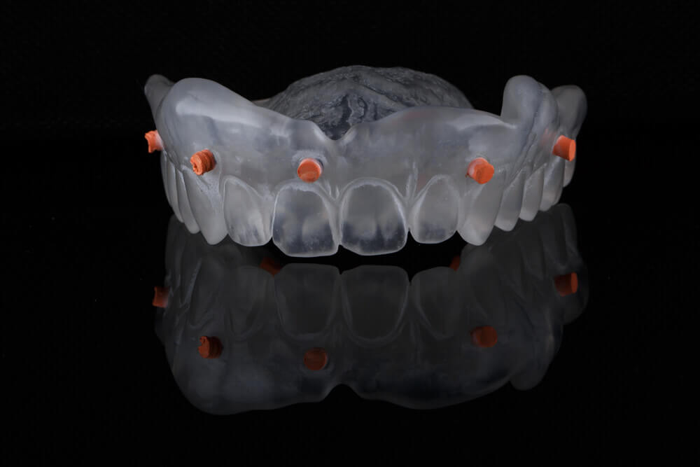 Dental Impressions Digital Impression Cost and benefits iSmile